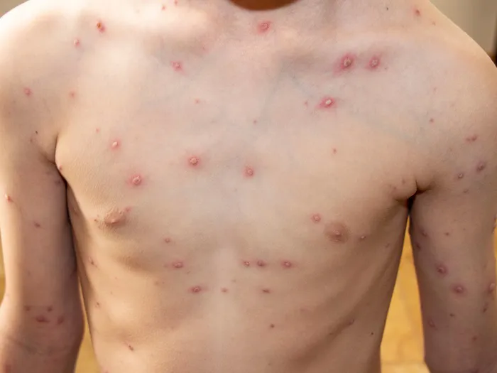 Erupción cutánea típica de la varicela